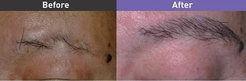 植眉手術前及術後1年。