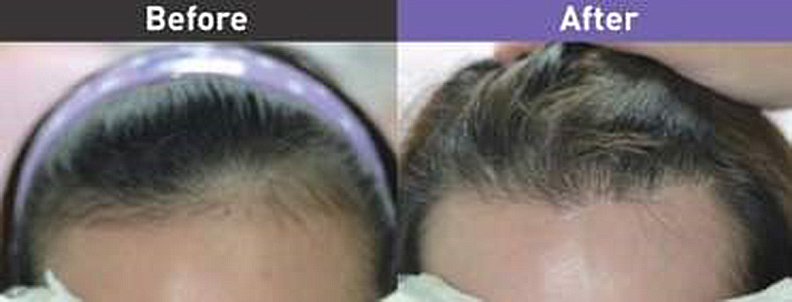 女性雄性禿植髮前後。