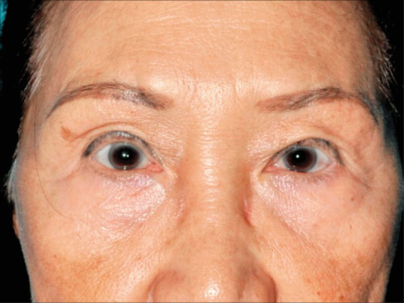 眼皮手術過分追求眼睛變大,眼神可能變凶。(照片提供/林靜芸)