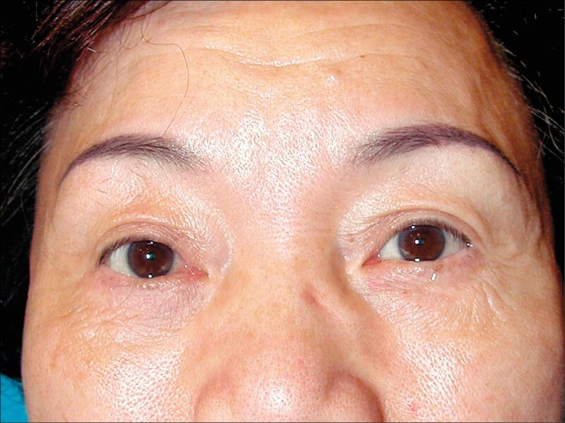 眼皮手術除了追求眼睛睜大,也該有開朗快樂的眼神。(照片提供/林靜芸)