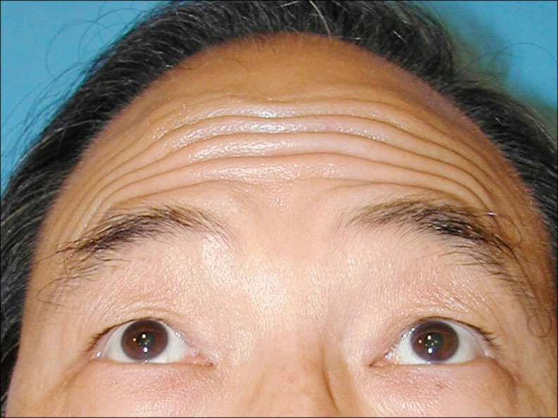 額頭寬或顴骨高的人,額頭肌無法拉提眼(眉)尾。(照片提供/林靜芸)