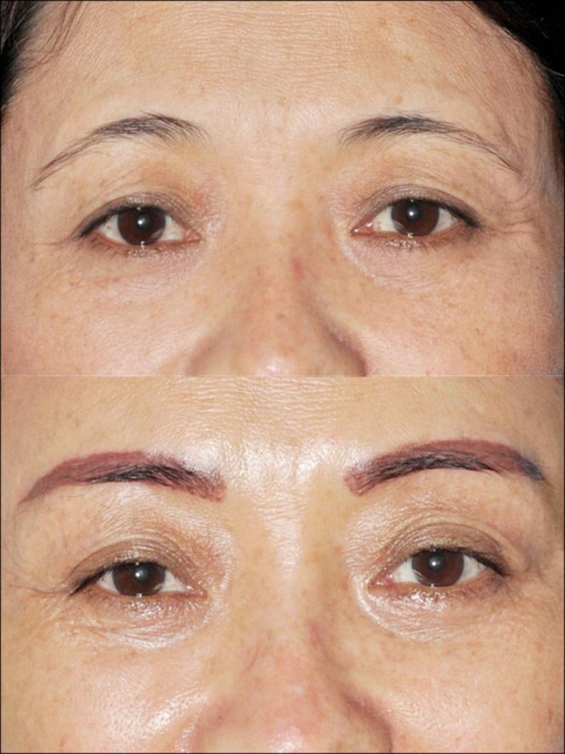 皮下剝離讓眉尾脫離額頭肌的黏連,才能矯治眼(眉)尾下垂。(照片提供/林靜芸)