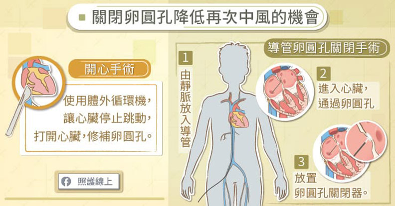 關閉卵圓孔降低再次中風的機會。
