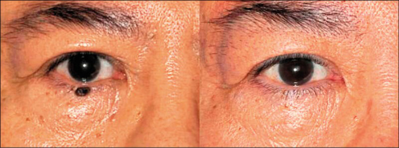 表淺的痣可以用雷射氣化處理。林靜芸提供