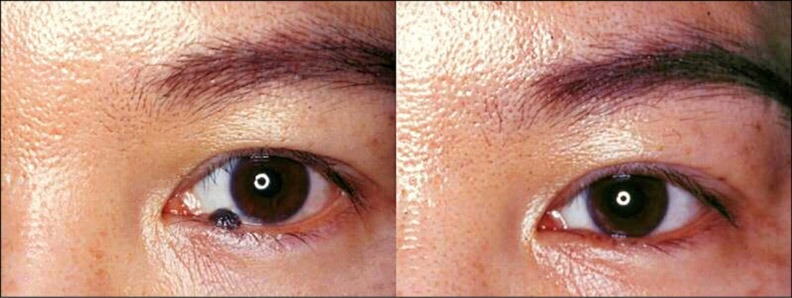 眼瞼邊緣深層凸出的痣,適用手術切除。林靜芸提供