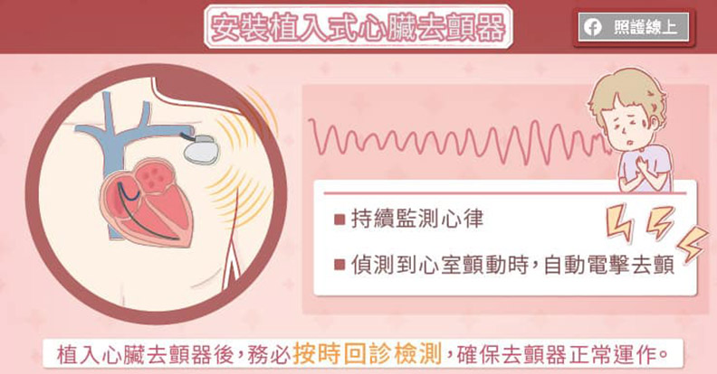 安裝植入式心臟去顫器。