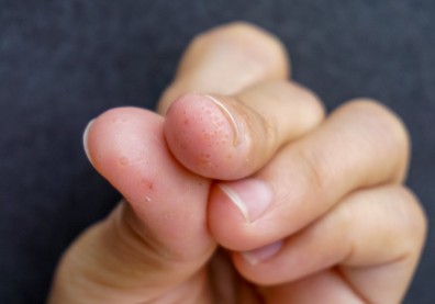 手腳小水泡好癢？汗皰疹發作有３原因，６招避免復發