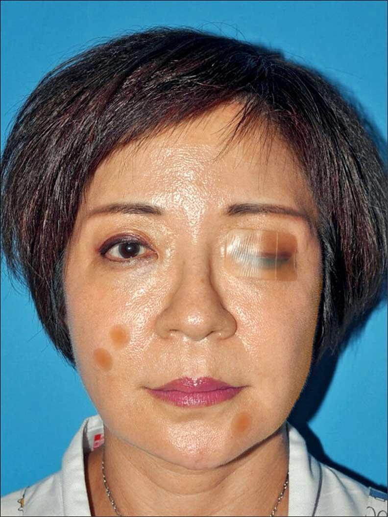 乾眼症的人可以用人工皮黏合上下眼皮,減少角膜摩擦,並防止淚水蒸發。林靜芸提供