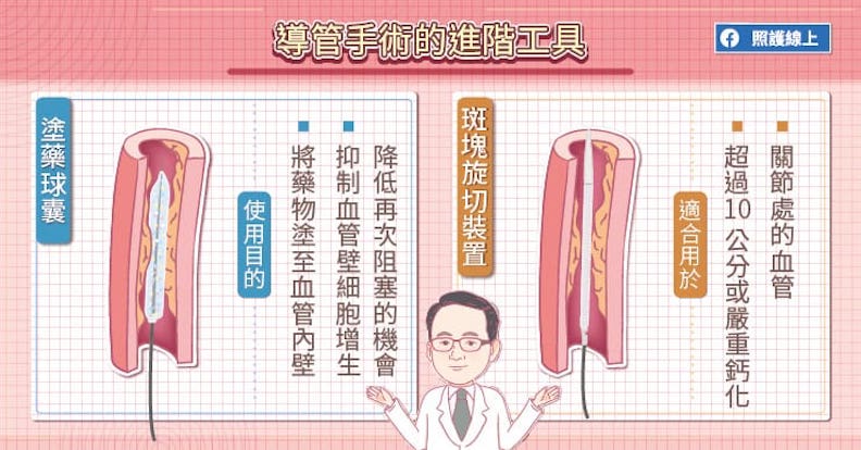 導管手術的進階工具。