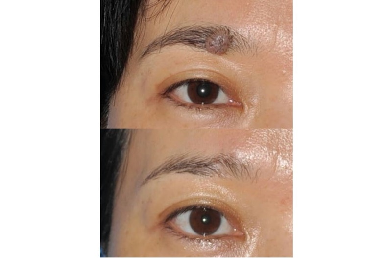 眉毛內的傷口必須儘量保留毛囊。