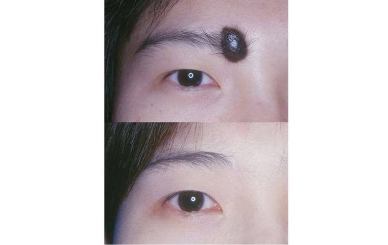 眉毛周緣傷口不會明顯。