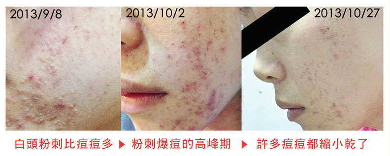 白頭粉刺比痘痘多 → 粉刺爆痘的高峰期 → 許多痘痘都縮小乾了