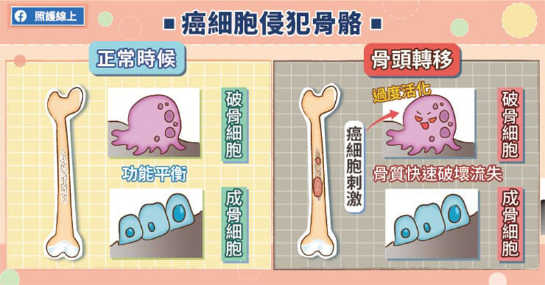 癌細胞侵犯骨骼。