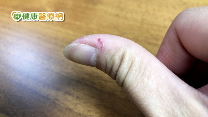 出現指甲倒刺並非缺乏維生素,也不代表身體出現異常狀況,陳逸懃醫師強調,網路上有許多危言聳聽的農場文章,多數缺乏專家背書,不足以採信。原因非常單純,就是因為指甲與皮膚太乾燥而已。