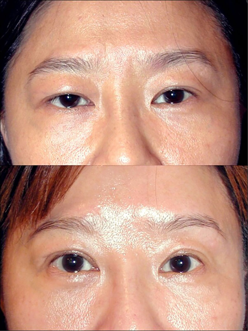 臥蠶讓眼神溫柔有笑意,保留臥蠶是眼皮手術很重要的課題。林靜芸提供