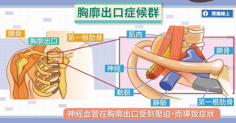 胸廓出口症候群。