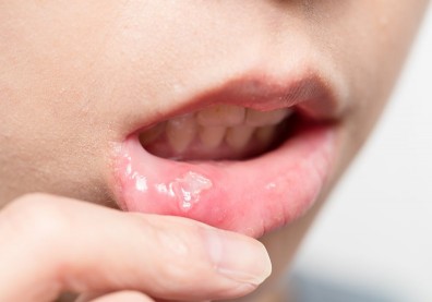 免疫力低造成口腔潰瘍，１年內出現３次恐罹患貝賽特氏症！