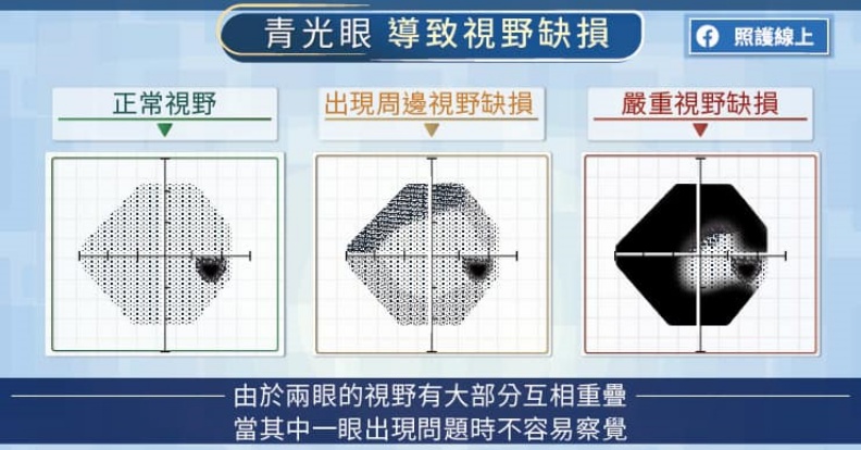 青光眼導致視野缺損。取自照護線上