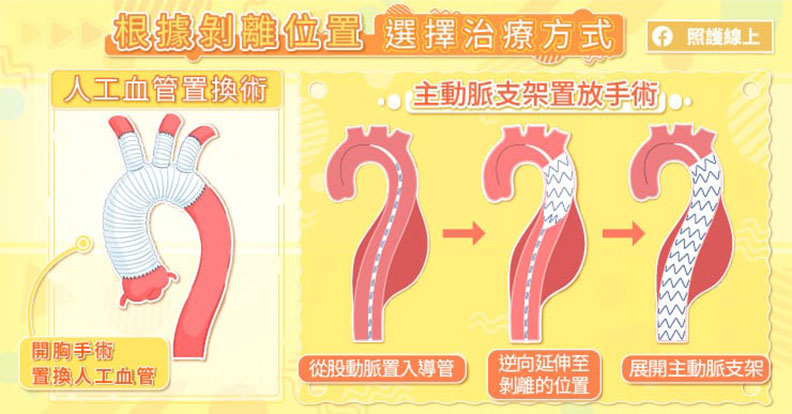 根據剝離位置選擇治療方式。取自照護線上