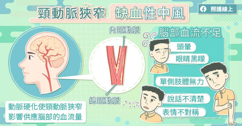 頸動脈狹窄 缺血性中風。取自照護線上