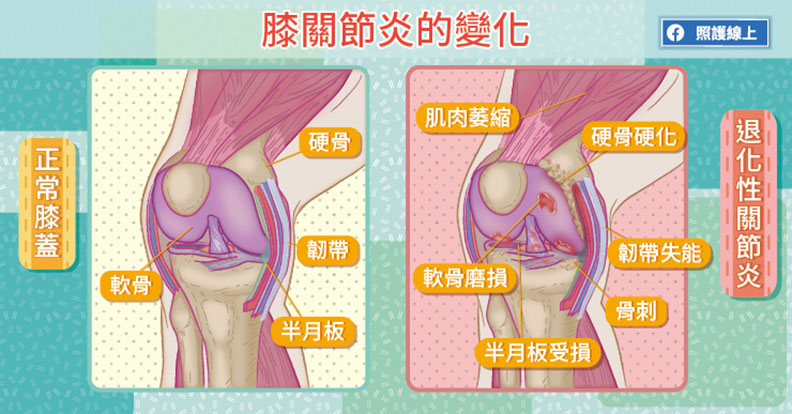 膝關節炎的變化。取自照護線上