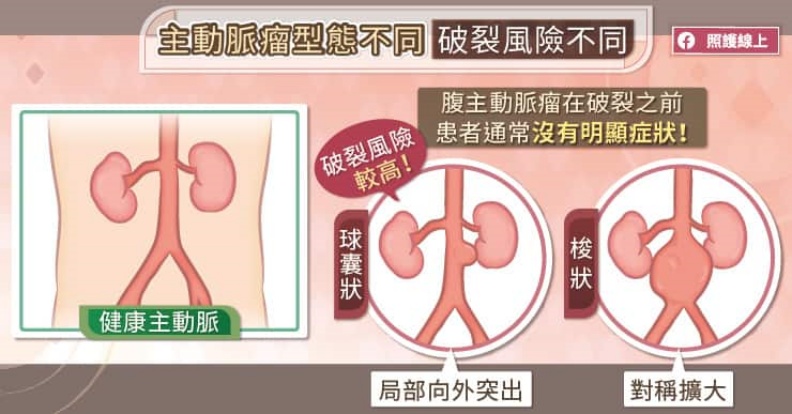 主動脈瘤型態不同,破裂風險不同。取自照護線上