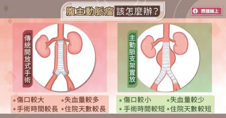 腹主動脈瘤該怎麼辦?取自照護線上