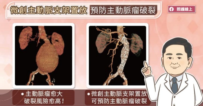 微創主動脈支架置放,預防主動脈瘤破裂。取自照護線上