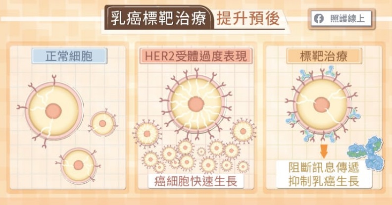 乳癌標靶治療提升預後。取自照護線上