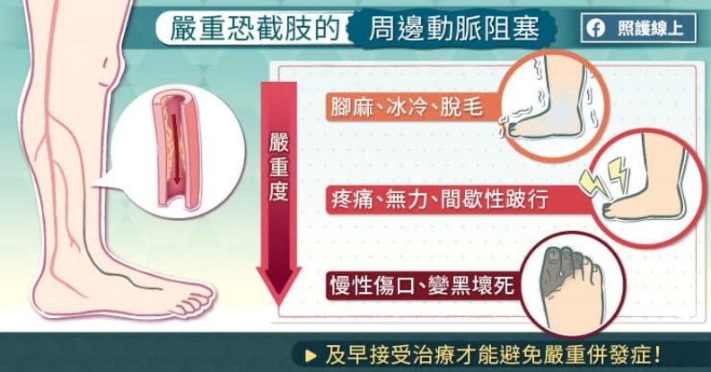 嚴重恐截肢的周邊動脈阻塞。取自照護線上