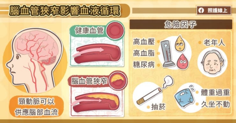 腦血管狹窄影響血液循環。取自照護線上