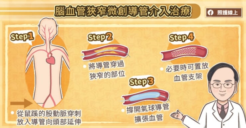 腦血管狹窄微創導管介入治療。取自照護線上