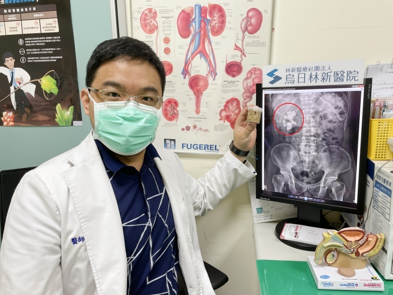 烏日林新醫院泌尿科蕭惟中醫師表示,鹿角形腎結石大多是結石長期阻塞所造成,發生率大約佔了10~15%,是腎結石中較難處理的結石類型。烏日林新醫院提供