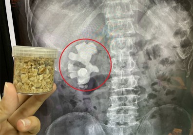 腎結石沒追蹤，竟長成8公分鹿角狀！醫：延誤治療恐需終身洗腎