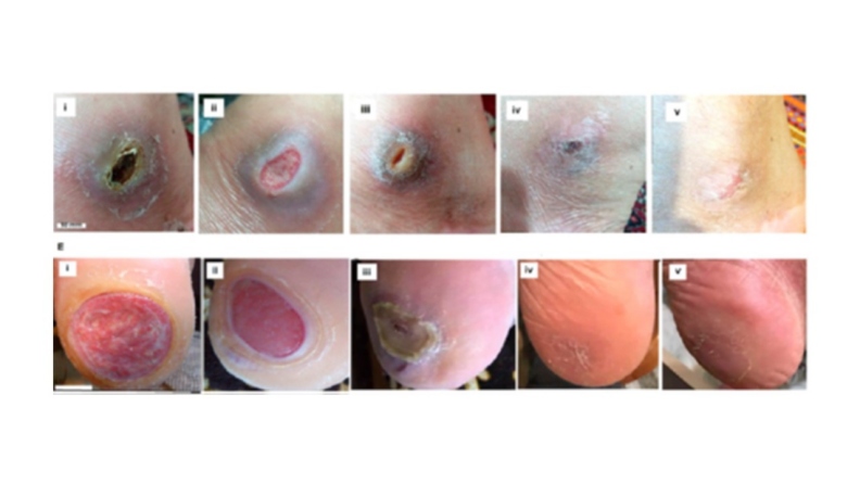 上排圖:一名70多歲、有糖尿病、男性患者,在腳踝(腓骨)處有一個慢性傷口,情況如(i)所示。經使用新一代、廉價的納米纖維貼片後,(ii)是使用7天後的傷口,(iii)14天,(iv)21天,和(v)7周後的復原情形。下排圖: 另一名71歲糖尿病患者,在腳底處有一慢性傷口,如(i)所示,長條白線(Scale bar)為1公分長。(ii)是使用新一代、廉價的納米纖維貼片3天後的情形,(iii)5天後,(iv)7周後,以及(v)11周後,復原情況良好。節錄自參考文獻