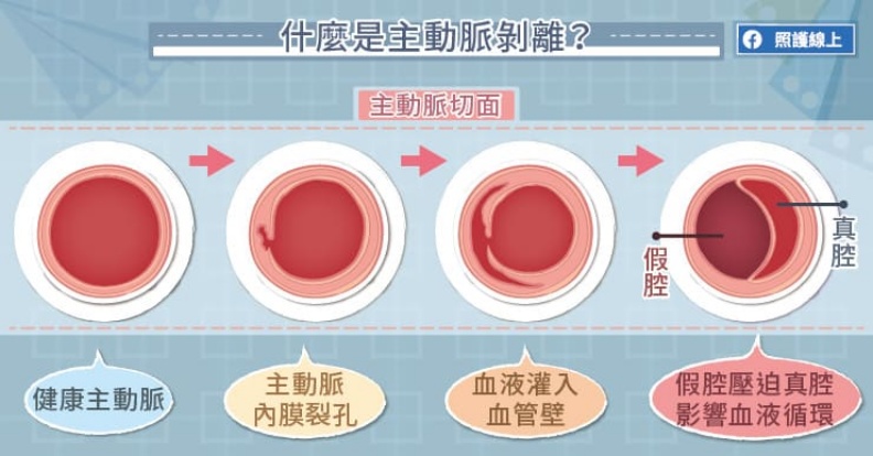 什麼是主動脈剝離?取自照護線上