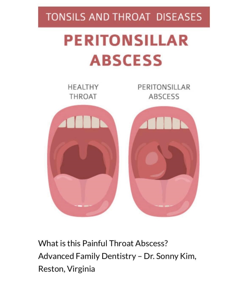 扁桃腺周圍膿瘍(Peritonsillar abscess)。取自Advanced Family Dentistry