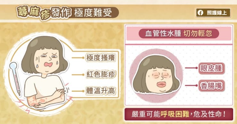 蕁麻疹發作極度難受。取自照護線上