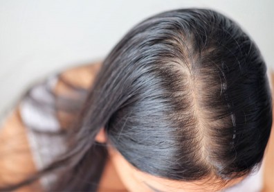 「拔一根長三根」白頭髮最好別拔？醫師：不想禿頭、長不出新髮小心這些事