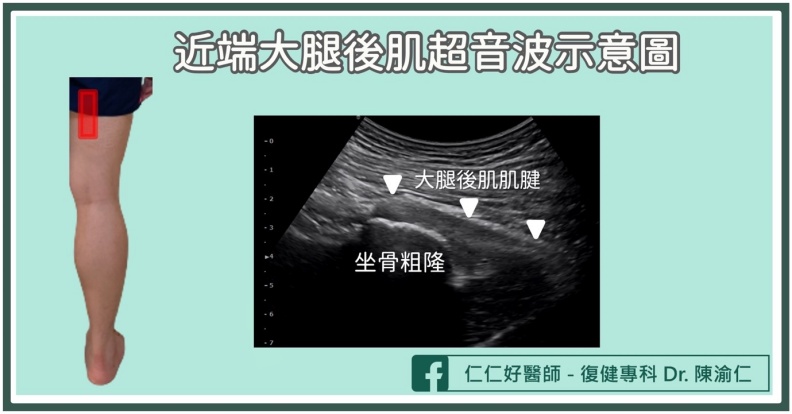 近端大腿後肌超音波示意圖。陳渝仁醫師提供