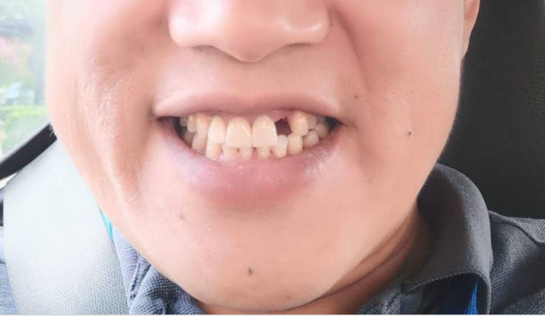 統計發現,牙齒脫落的程度和認知功能之間存在顯著的負相關,亦即牙齒掉落的越嚴重,腦機能傾向會變得越差。柯俊銘心理師提供