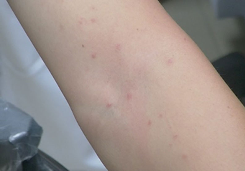 澎湖多位居民最近皮膚出現大量紅疹,醫師評估以「毛毛蟲皮膚炎」可能性最大。取自聯合新聞網