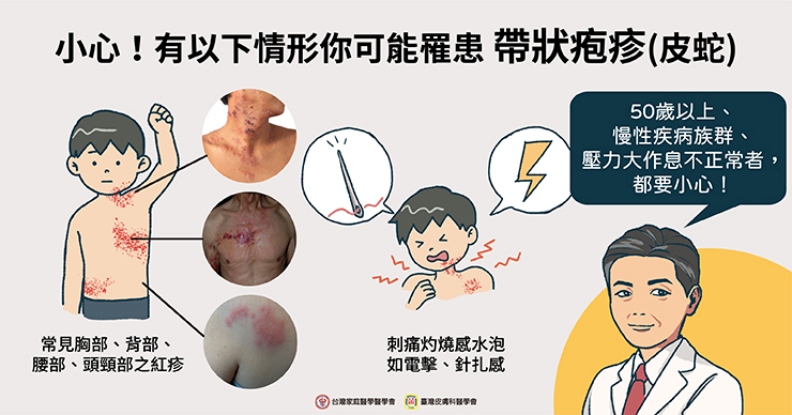 小心!有以下情形你可能罹患帶狀泡疹(皮蛇)。取自照護線上