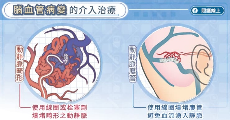 腦血管病變的介入治療。取自照護線上