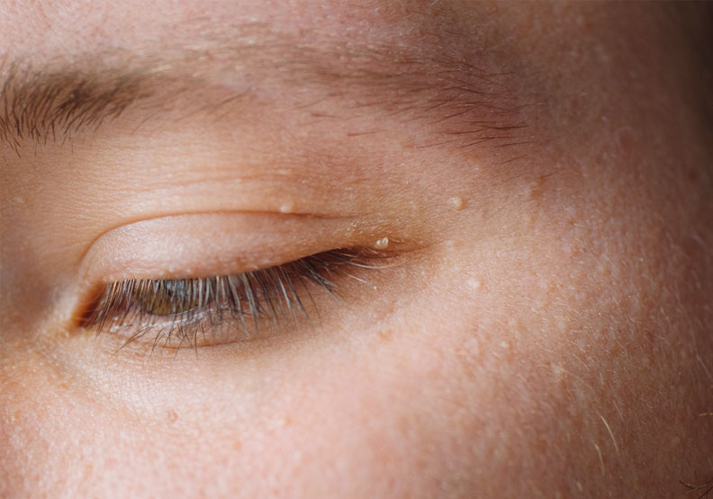 眼周長小顆粒、肉芽，是保養品太滋潤？皮膚科醫師解答８種可能狀況