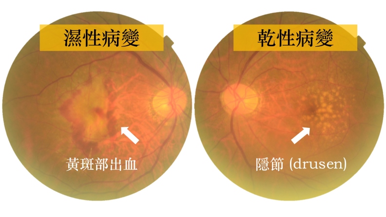 圖一、黃斑部濕性與乾性病變。亞東紀念醫院提供