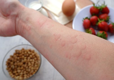 皮膚紅腫癢，慢性蕁麻疹與食物無關？避開４大生活雷區助改善