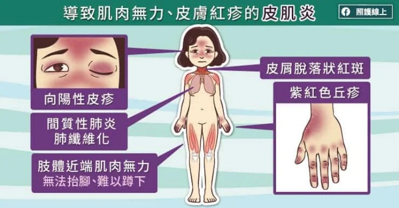 導致肌肉無力、皮膚紅疹的皮肌炎。照護線上提供