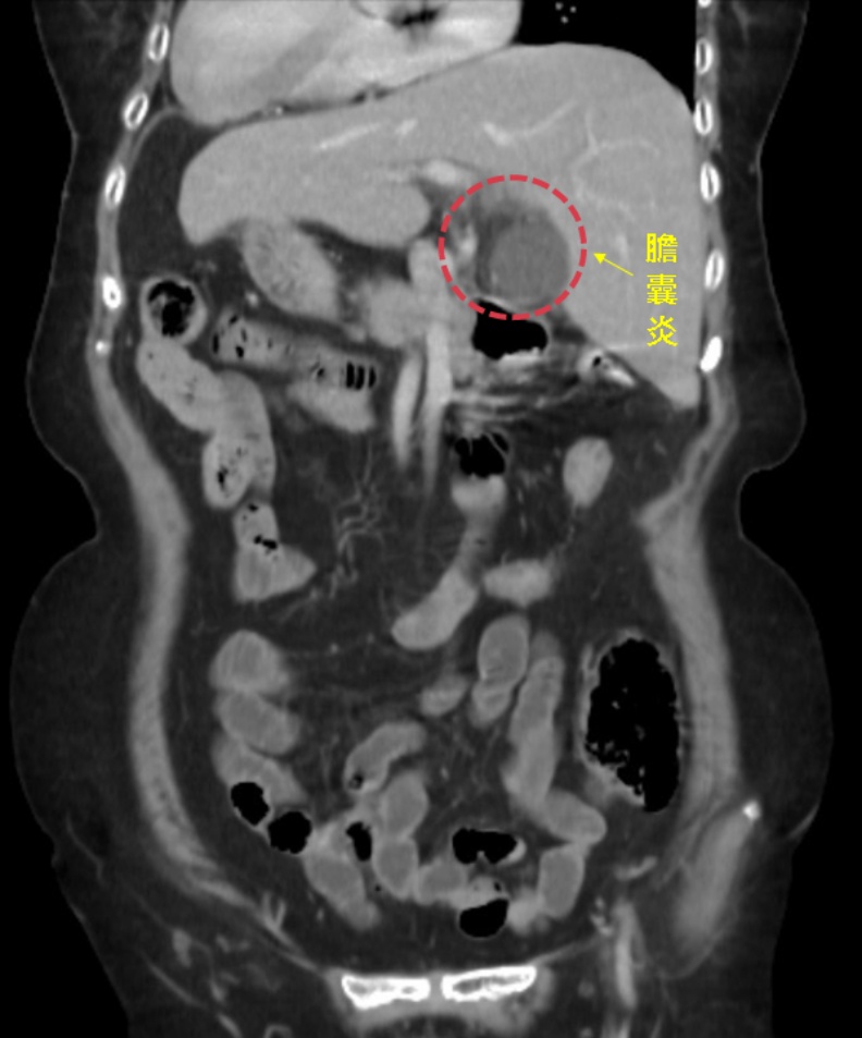 膽囊炎。中國醫藥大學新竹附設醫院提供
