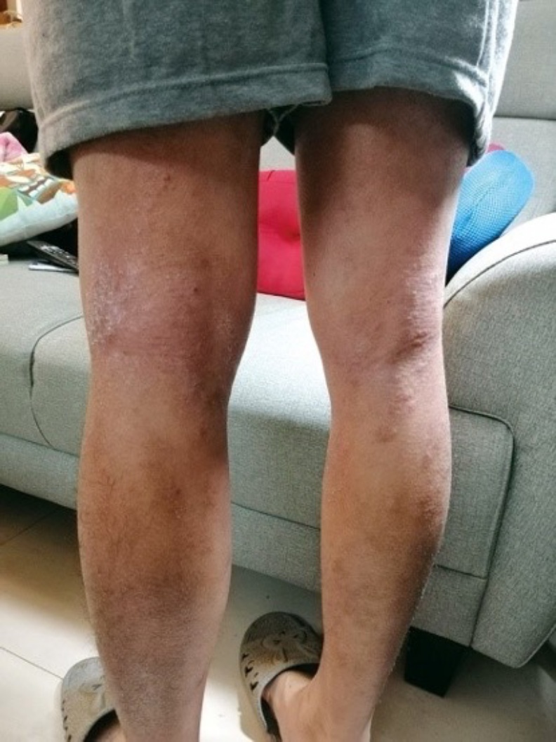 異位性皮膚炎病友協會提供。